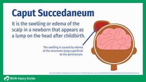 Caput Succedaneum: Causes, Treatment and More - Birth Injury Guide