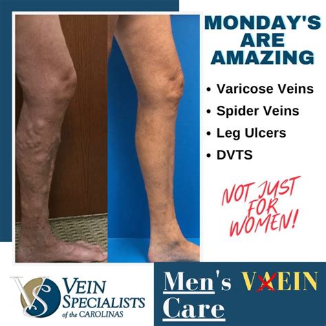 Mens Vein Care Mondays Are Amazing Vein Specialists Of The Carolinas