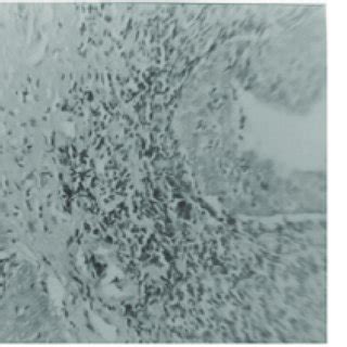 Esophageal mucosa with squamous epithelium (right side). There is ...