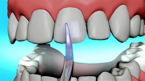 What is the procedure of teeth bonding before and after?