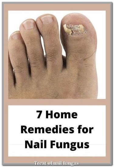 11 Home Remedies For Toenail Fungus That Actually Work Artofit