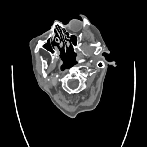 Fileacute Right Mca Infarct Meningioma And Retinal Detachment Ct