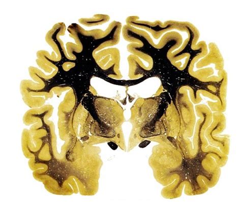Frontal Section Through Telencephalon And Diencephalon Diagram Quizlet