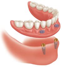 Dental Implants Amarillo, Denture Implants Amarill - Dental Implants...