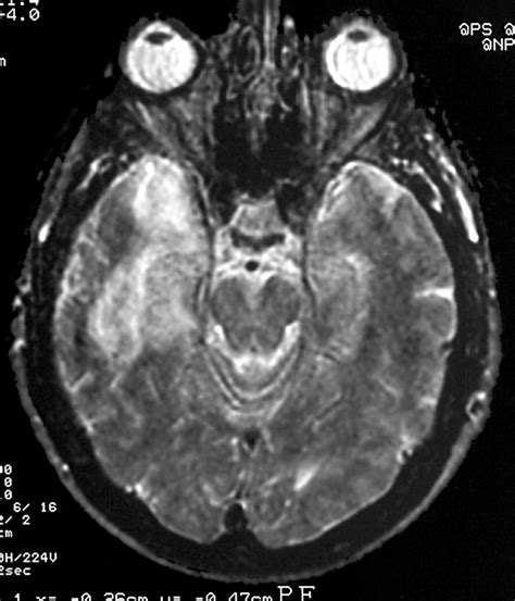 Neurosyphilis With Complex Partial Status Epilepticus And Mesiotemporal