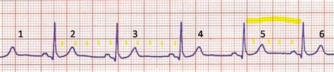 Análisis Del Ritmo Cardíaco Cerebromedico