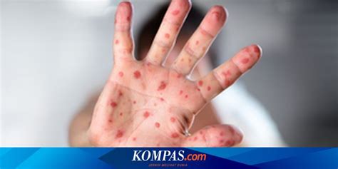 Cara Mengobati Gatal Gejala Flu Singapura Jangan Sembarangan Digaruk