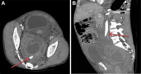 Axial Contrast Enhanced Computed Tomography Scan Showing A Large