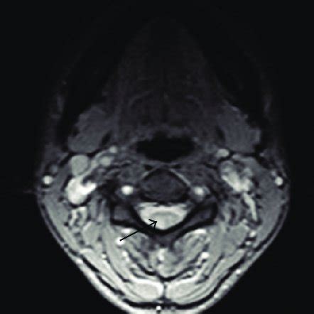 MRI 1 5T Axial Section Obtained With Sequence GRE T2 At C4 Level