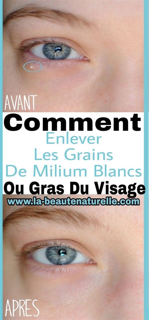 Comment Enlever Les Grains De Milium Blancs Ou Gras Du Visage Visage