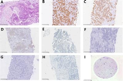 Frontiers Case Report Persistent Response To Combination Therapy Of