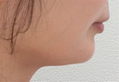 輪郭注射mlmでスッキリ小顔に！横顔もシャープになりました。 表参道美容外科クリニック