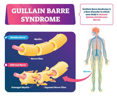 What is Guillain Barré Syndrome Symptoms and Causes Explained Brain