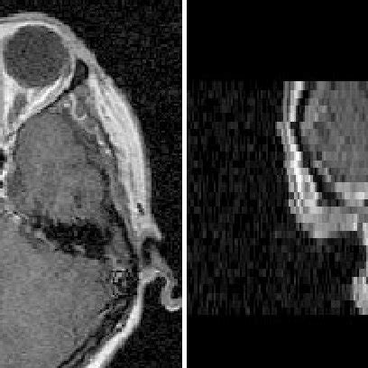 In This Multislice Spin Echo T1 Weighted MR Image Slices In The Axial