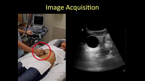 Gallbladder Point Of Care Ultrasound Tutorial Youtube