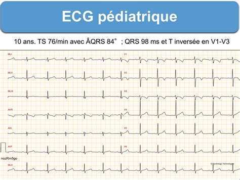 ECG pédiatrique Urgence CHU Sainte Justine