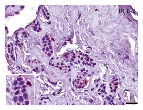 Immunomarking for HIF 1α IAP 2 GLUT1 and Bcl 2 in AMB and FP HIF 1α