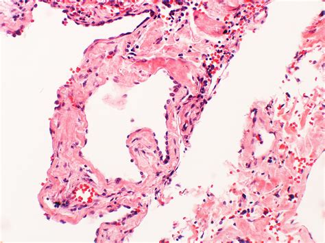 Amyloidosis Diffuse Focal Alveolar Septal Involvement Atlas Of Pulmonary Pathology Flickr