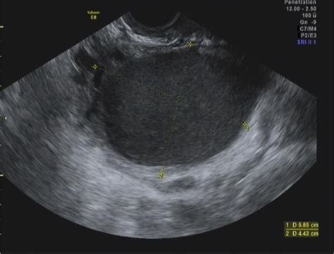 Ovarian Cyst Observed On Transvaginal Ultrasound In A Year Old Hot