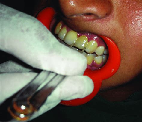 Tooth Width Measurement For The Maxillary Left Lateral Incisor