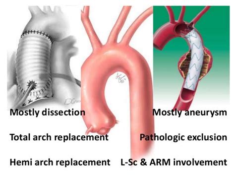 AORTIC ARCH SURGERY