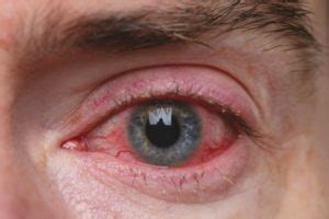 What is Ocular Rosacea? Causes and Treatments - The Eye News