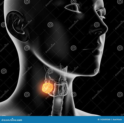 Thyroid Cancer Of A Woman Medically D Illustration On Black