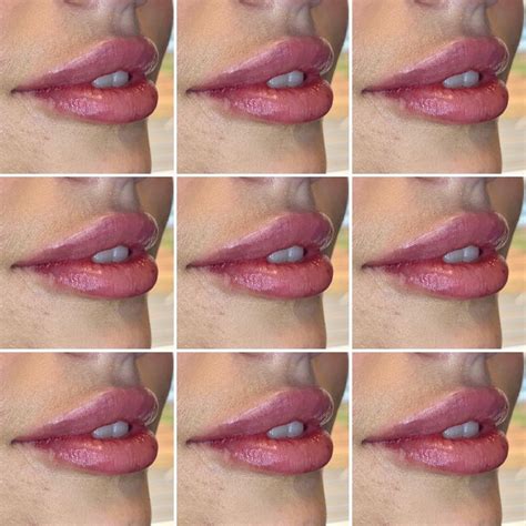 Aesthetic Dermatology Restylane Lip Fillers Syringe Fda Needle