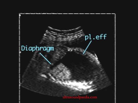 Pleural Effusion Ultrasound