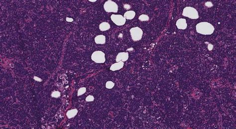 Nodal Marginal Zone Lymphoma Ottawa Atlas Of Pathology