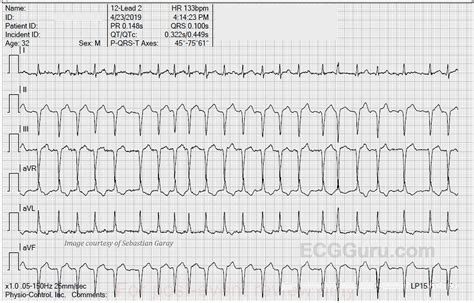 Atrial fibrillation | ECG Guru - Instructor Resources