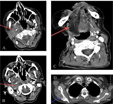 A 65 Year Old Female With A Prolonged History Of Recurrent Pleomorphic Download Scientific