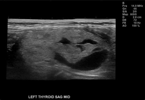 Thyroid Ultrasound