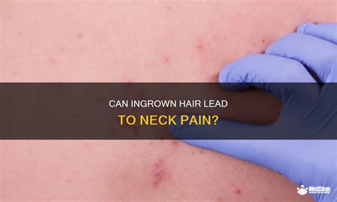 Can Ingrown Hair Lead To Neck Pain Medshun