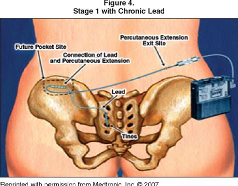 Figure 4 From Sacral Nerve Neuromodulation Interstim Part I Review Of The Interstim System