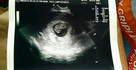 8 weeks pregnant. Saw heartbeat on the 25th second ultrasound on 27th ...