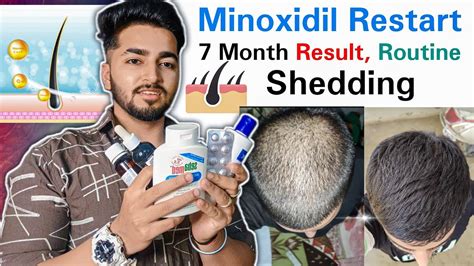 Minoxidil Restart Month Results Shedding Routine Minoxidil For