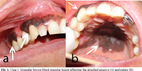 Figure From Oral Mucosal Melanoma Conservative Treatment Including