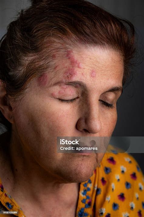 Hispanic Mature Woman With Herpes Zoster Infection On The Right Hand