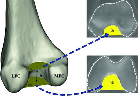 Axial Femoral Intercondylar Notch Area Measurement In The Posterior