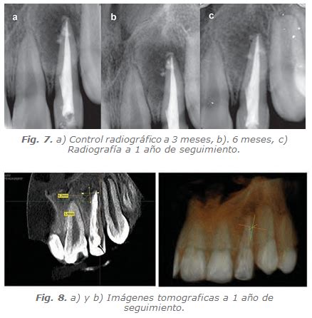 Revista Canal Abierto Endodontic Treatment Of A Tooth With Dens