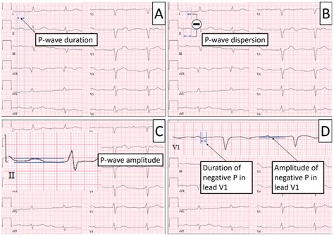 Measurement of ECG parameters. Panel (A)—P-wave duration is measured ...