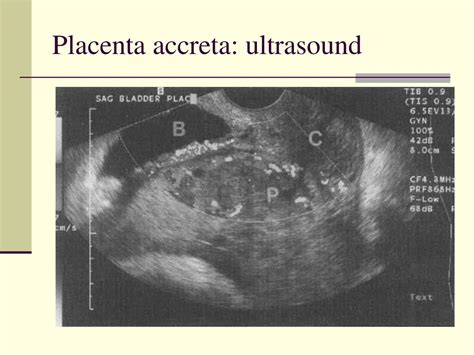 PPT - Placenta Previa PowerPoint Presentation, free download - ID:1091120