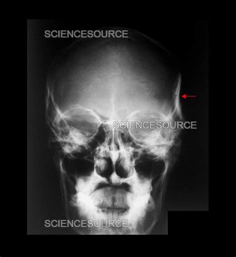 X-Ray of Skull Fracture | Stock Image - Science Source Images