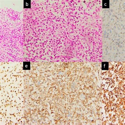 Primary Monophasic Synovial Sarcoma Of Lung Lung Window Coronal