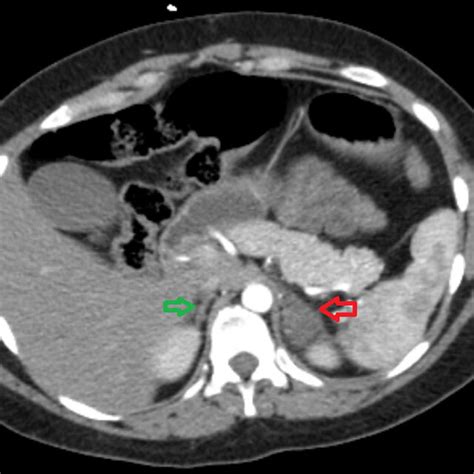 Ct Chest With Pe Protocol Showing The Incidental Finding Of A 1 9 Cm Download Scientific