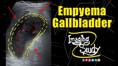 Empyema Gallbladder Ultrasound Case 322 Youtube