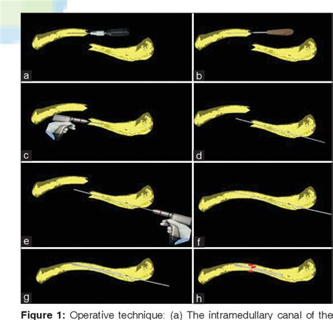 Figure From Management Of Acute Displaced Midshaft Clavicular