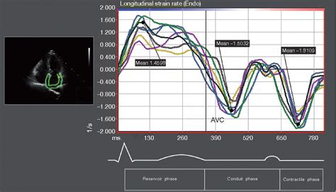 Figure 3 From Improvement Of Left Atrial Function And Left Atrial