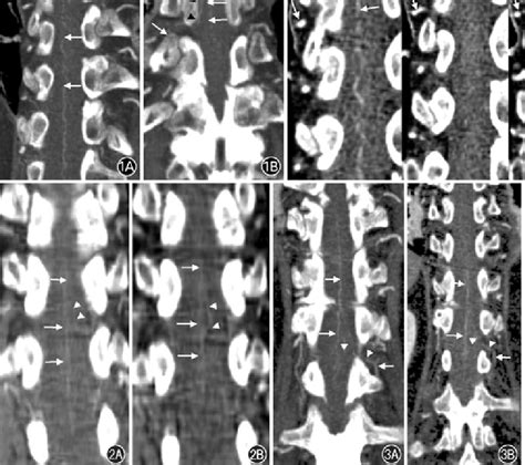 Mdct Scan Obtained With 1 25 Mm Scan Thickness In A 73 Year Old Female Download Scientific